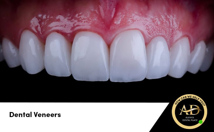 Dental Veneers Turkey
