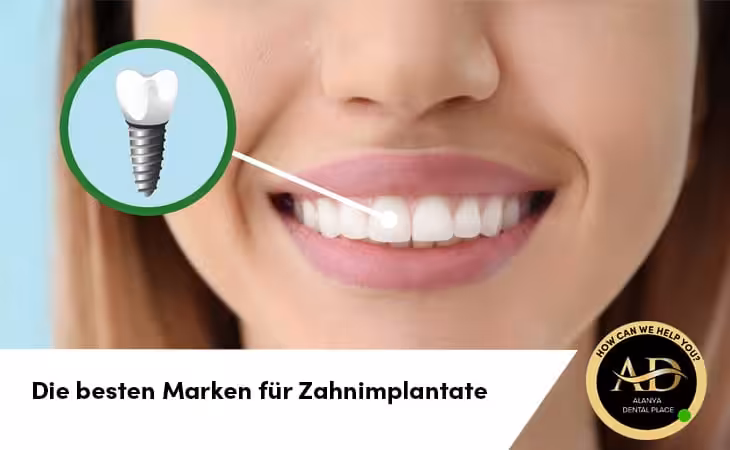 Die besten Marken für Zahnimplantate