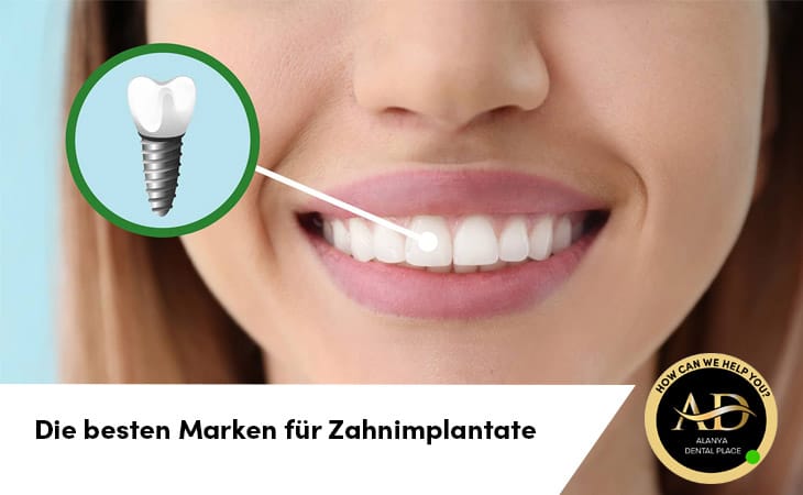 Die besten Marken für Zahnimplantate