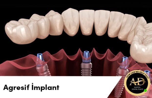 Agresif Diş İmplantı