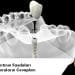 diş implantının faydaları