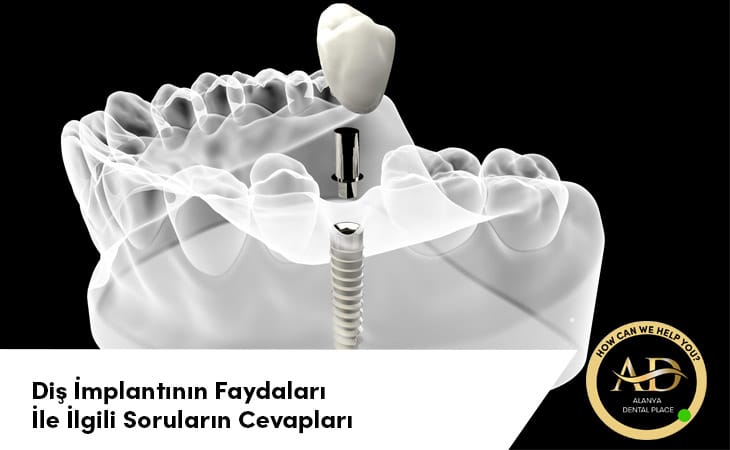 Diş İmplantının Faydaları ve İlgili Soruların Cevapları