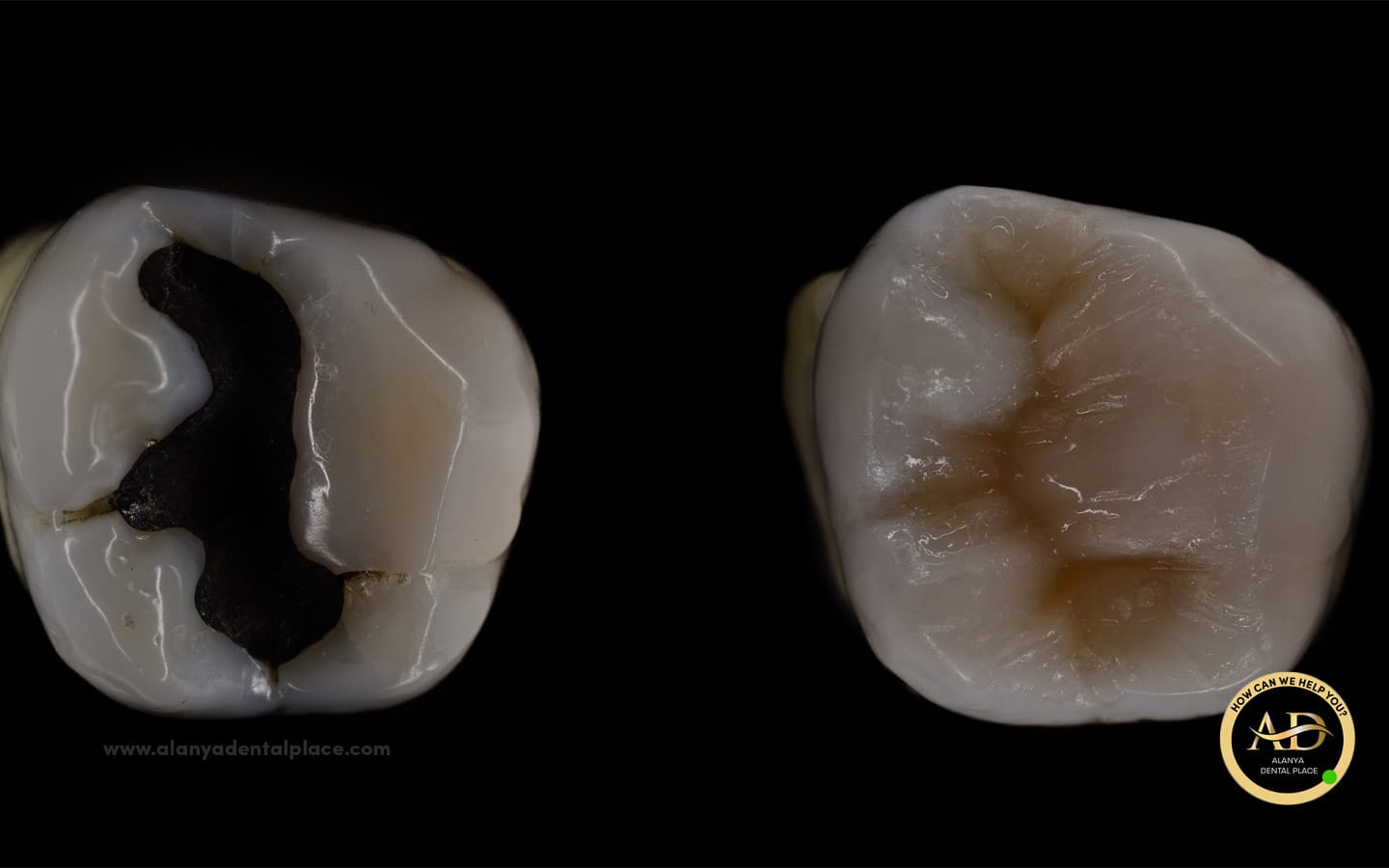 Dolgu Tedavisi 3 dolgu tedavisinde kullanılan malzemeler