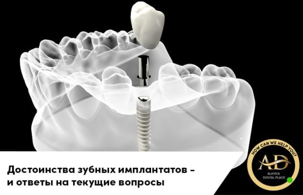 Достоинства зубных имплантатов и ответы на текущие вопросы