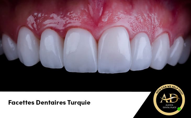 Facettes Dentaires Turquie