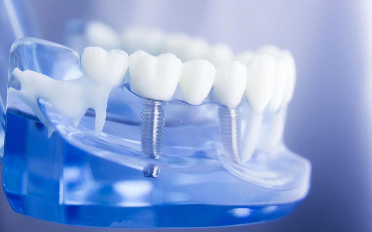 Full Mouth Dental Implant Treatment