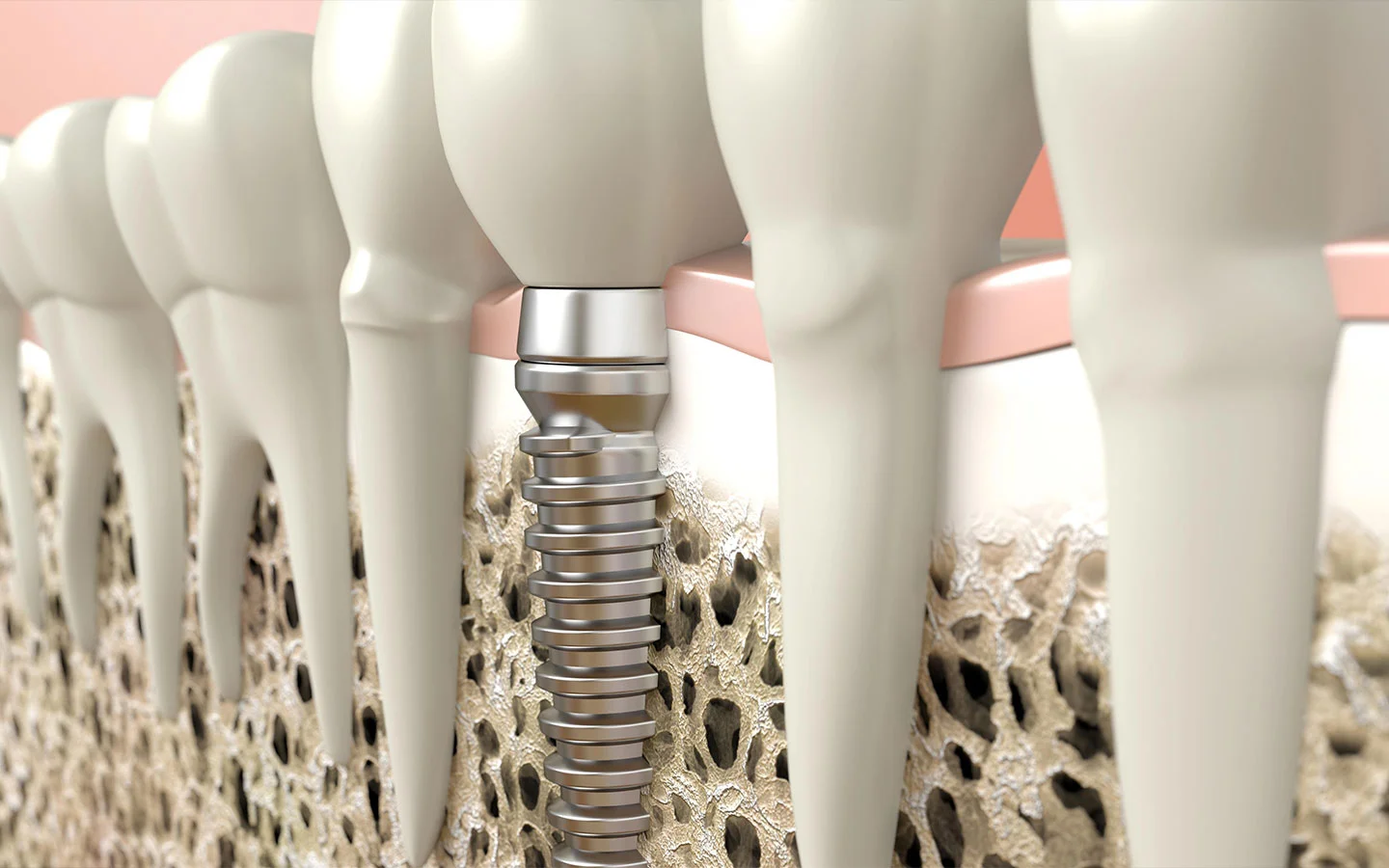 Full Mouth Dental Implant Treatment