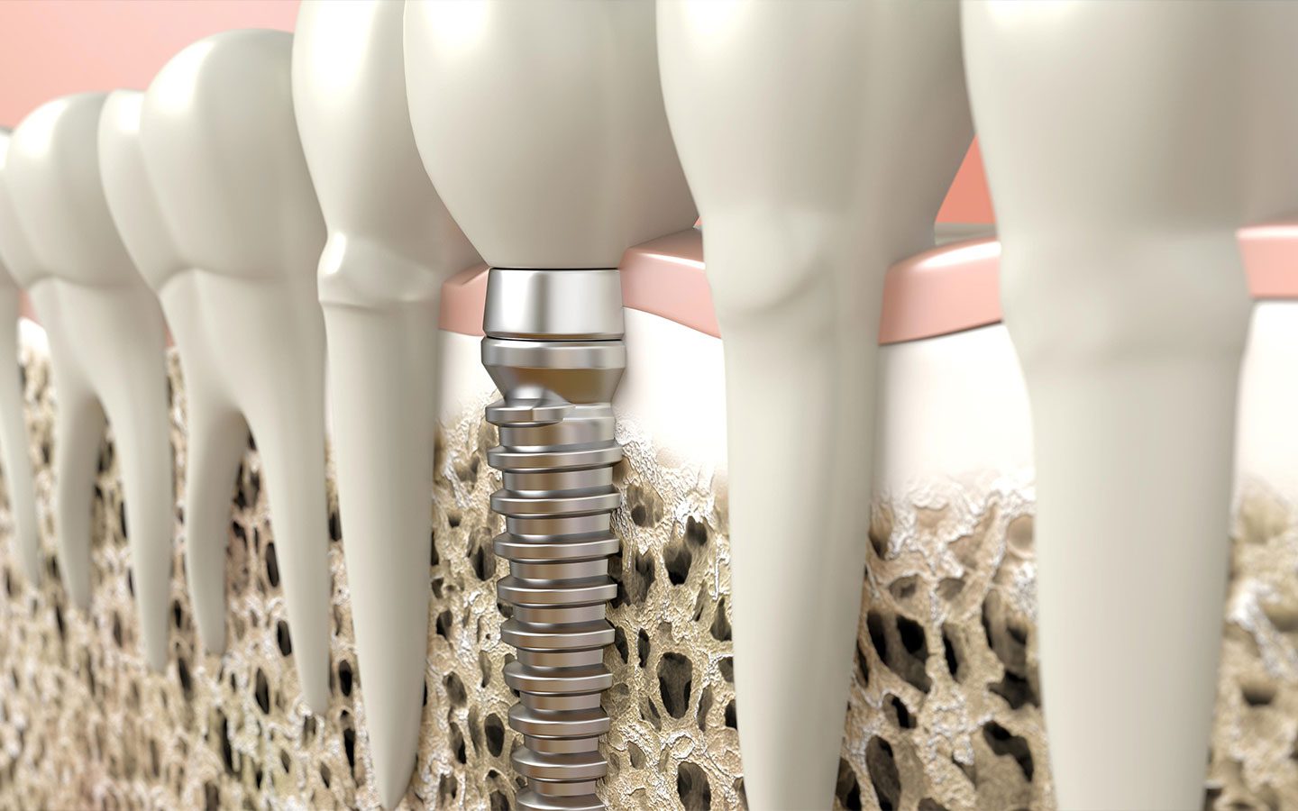 Implant de Bouche Complète