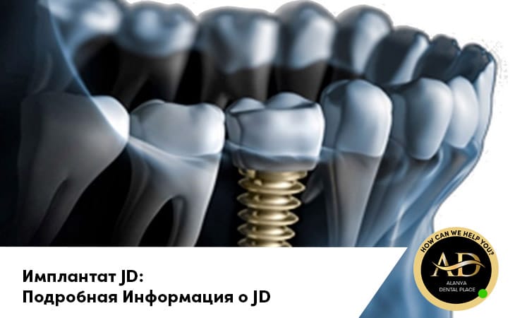 Имплантат JD: Подробная Информация о JD