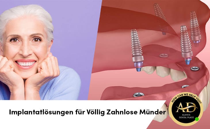 Implantatlösungen für Völlig Zahnlose Münder
