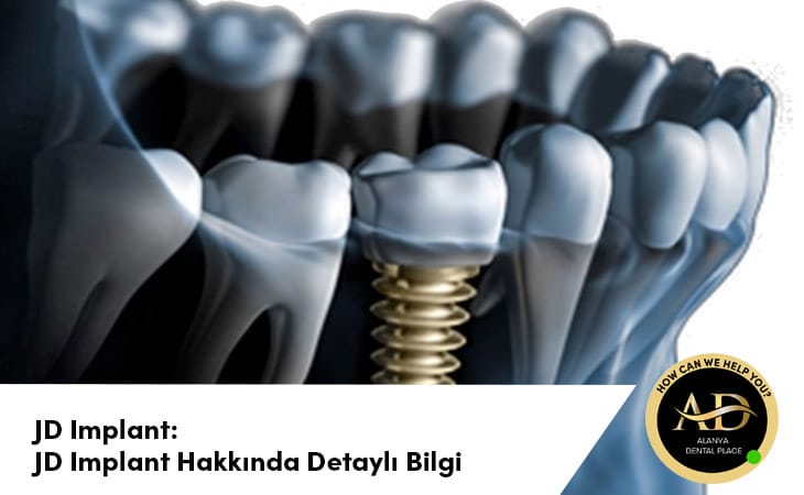 JD Implant: JD Implant Hakkında Detaylı Bilgi