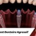 L’implant Dentaire Agressif