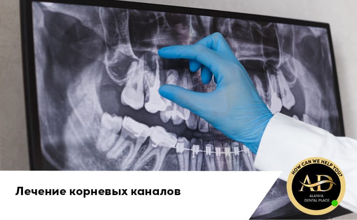 Лечение корневых каналов