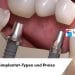 Megagenimplantat-Typen und Preise