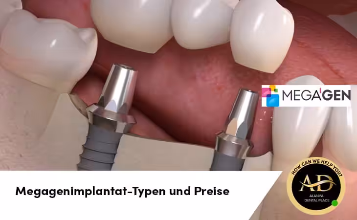 Megagenimplantat-Typen und Preise