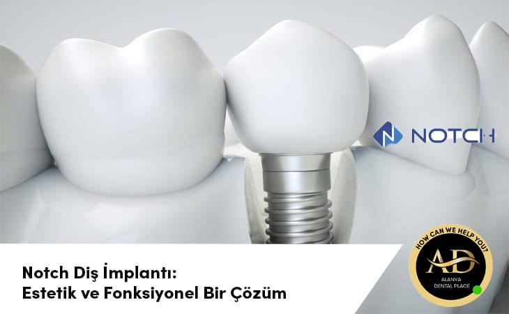 Notch Diş İmplantı: Estetik ve Fonksiyonel Bir Çözüm