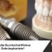 Preise-für-Zahnimplantate