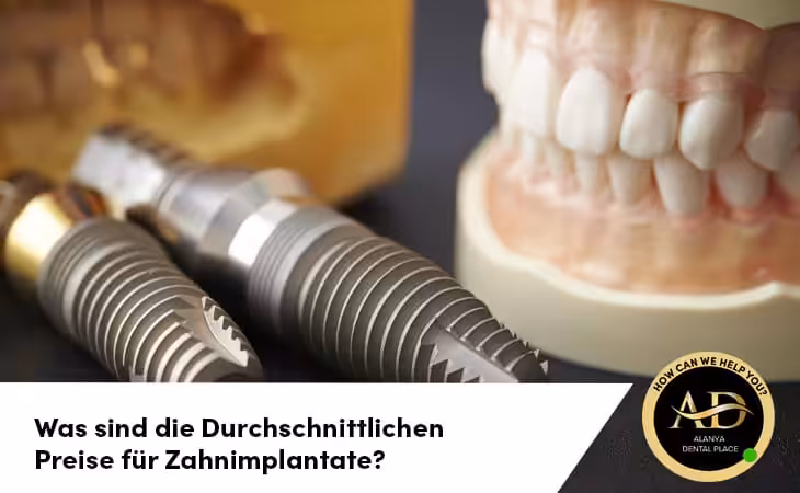 Was sind die Durchschnittlichen Preise für Zahnimplantate?