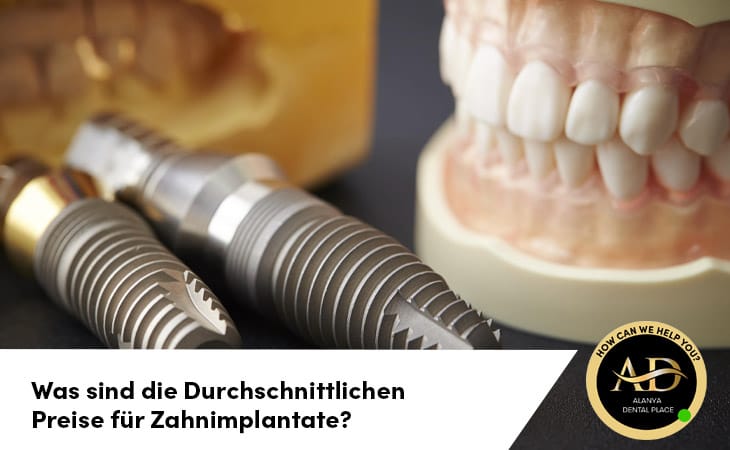 Was sind die Durchschnittlichen Preise für Zahnimplantate?
