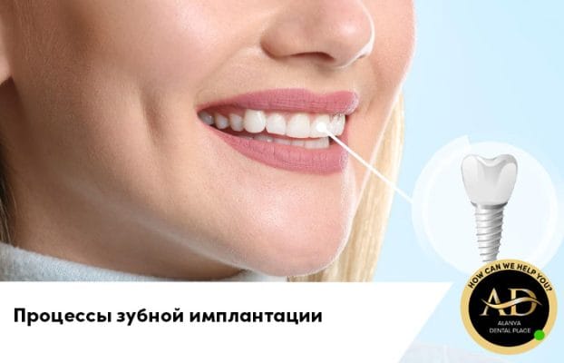 Процессы зубной имплантации и что нужно знать пациентам