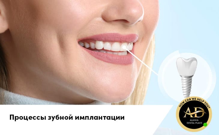 Процессы зубной имплантации и что нужно знать пациентам