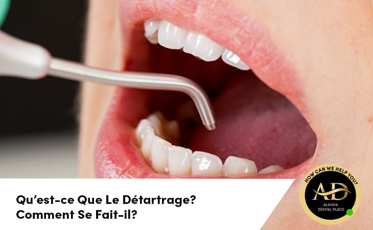 Qu’est-ce Que Le Détartrage? Comment Se Fait-il?