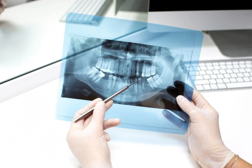 Questions asked about implant treatment