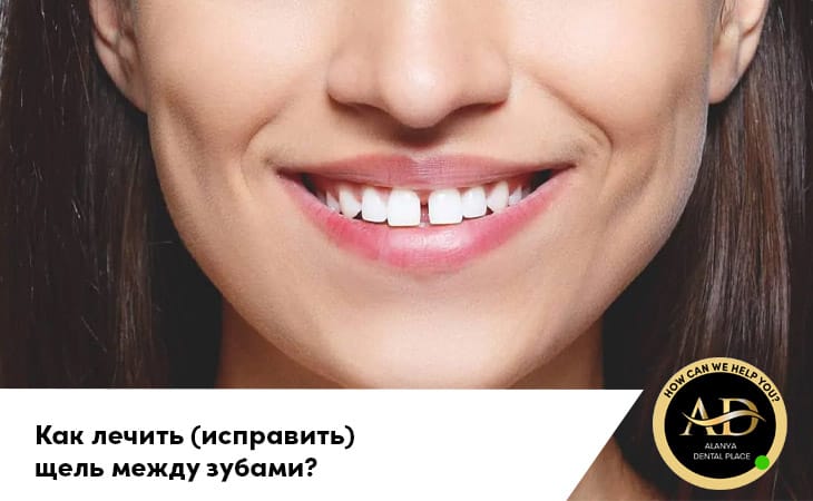 Как лечить (исправить) щель между зубами?