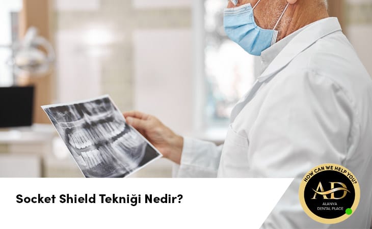 Socket Shield Tekniği Nedir?