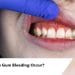 stop-bleeding-gums
