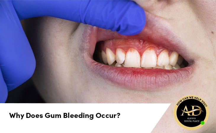 Why Does Gum Bleeding Occur? And How To Stop It?
