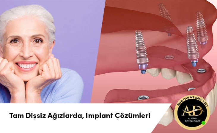 Tam Dişsiz Ağızlarda, Implant Çözümleri