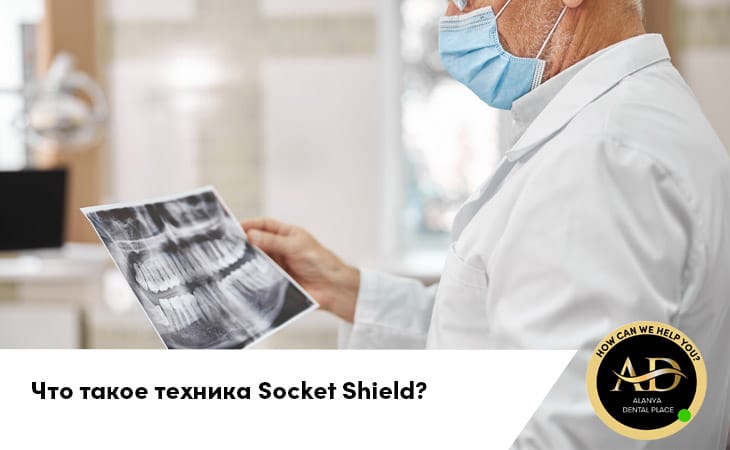 Что такое техника Socket Shield?