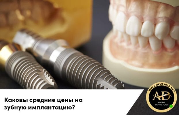 Каковы средние цены на зубную имплантацию?