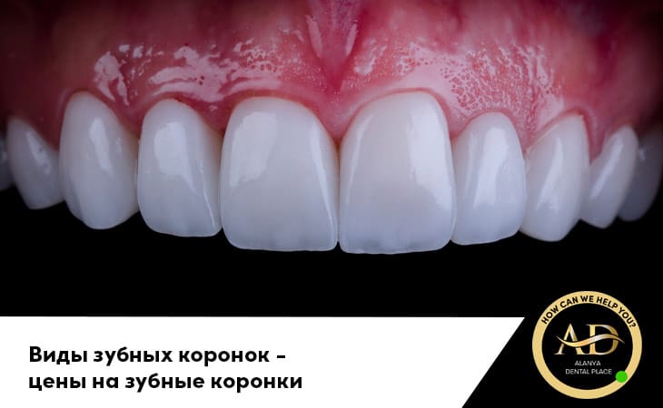 Виды зубных коронок и цены на зубные коронки