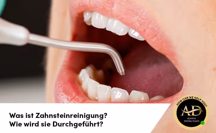 Was ist Zahnsteinreinigung? Wie wird sie Durchgeführt?