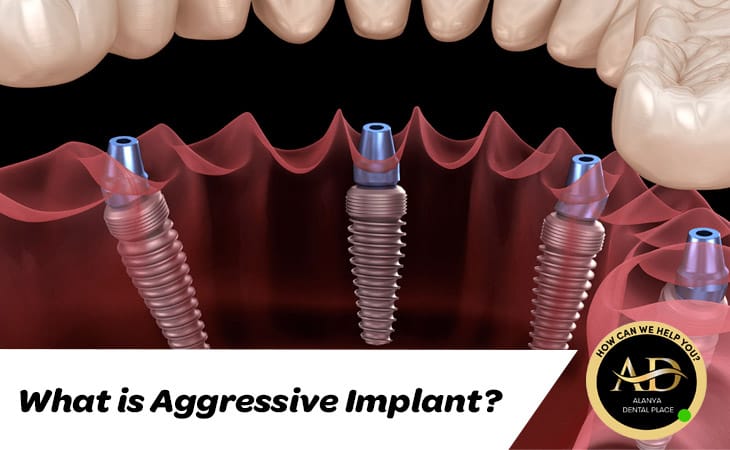 What is Aggressive Implant?