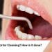 What is Tartar Cleaning