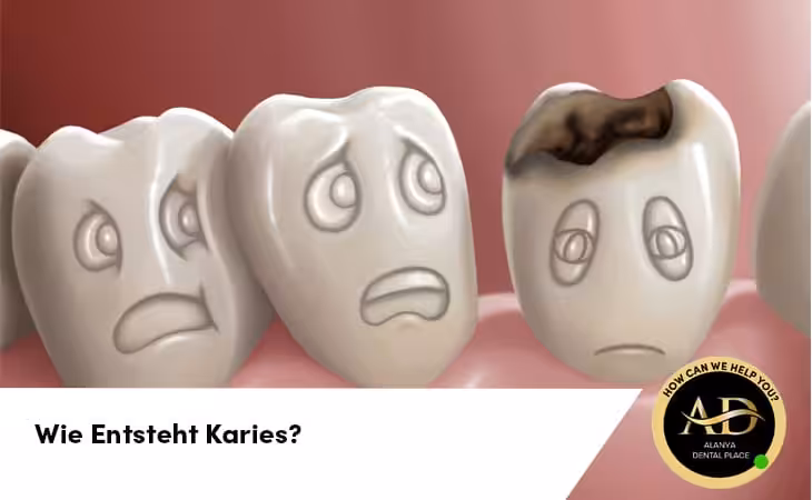 Wie Entsteht Karies?