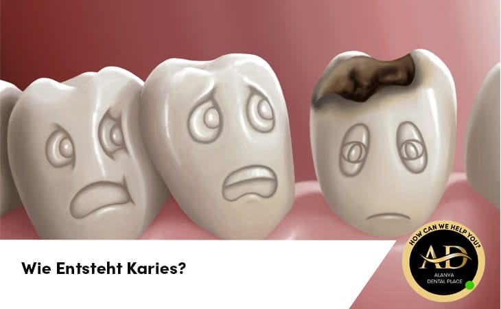 Wie Entsteht Karies?