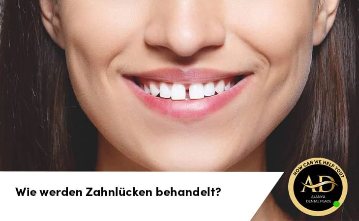 Wie werden Zahnlücken behandelt?