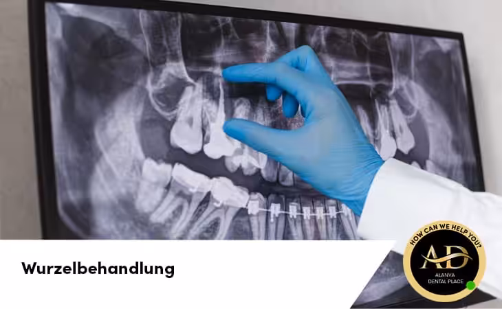 Wurzelbehandlung
