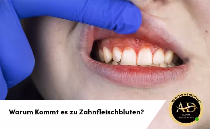 Warum Kommt es zu Zahnfleischbluten? Und wie kann man es Stoppen?