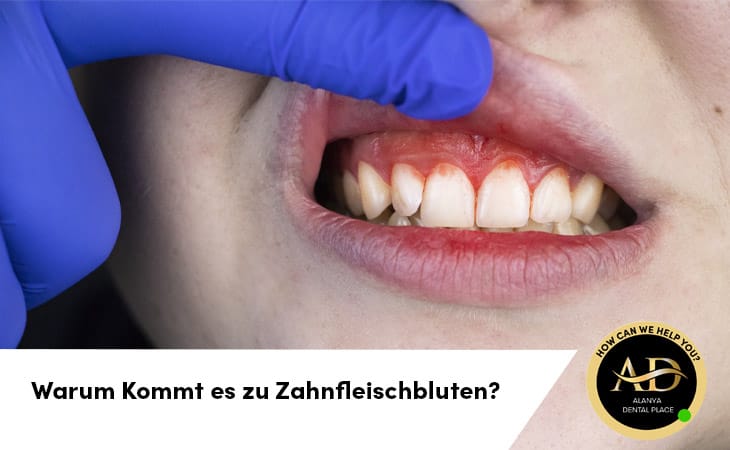Warum Kommt es zu Zahnfleischbluten? Und wie kann man es Stoppen?