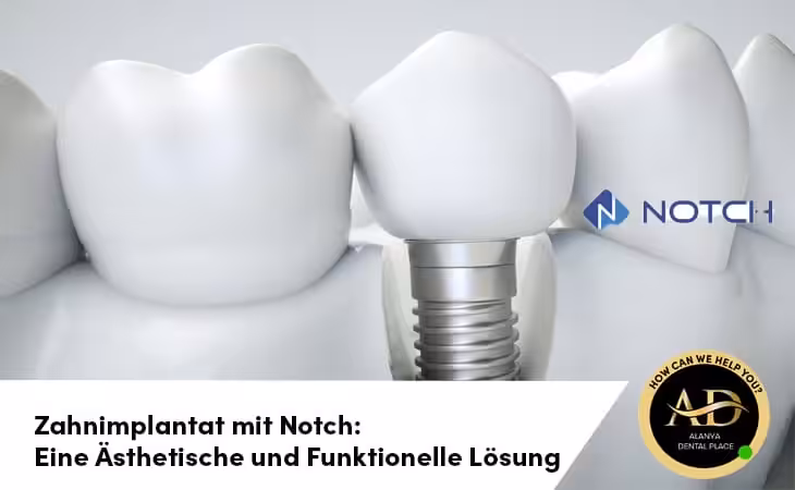 Zahnimplantat mit Notch: Eine Ästhetische und Funktionelle Lösung