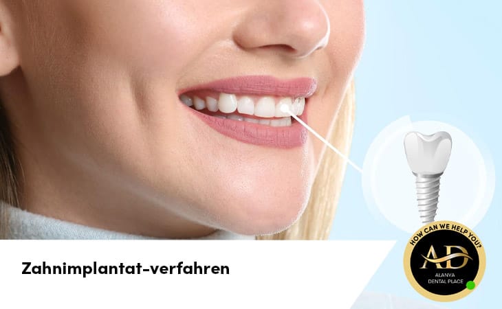 Zahnimplantat-verfahren und was Patienten Wissen Müssen