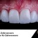 zahnveneers türkei preise