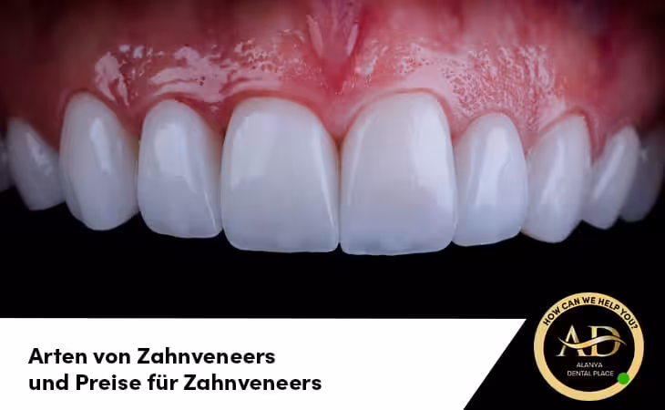 Arten von Zahnveneers und Preise für Zahnveneers
