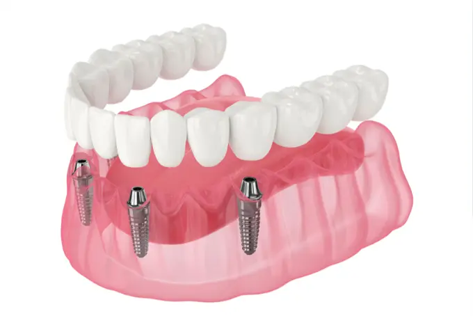 All On 4 İmplant