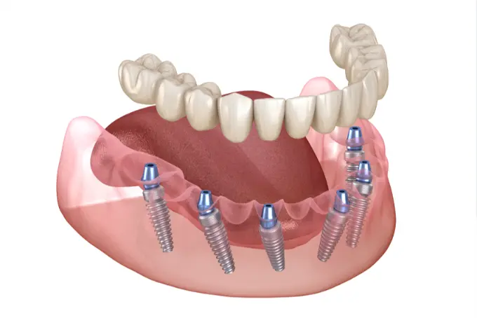 All On 6 İmplant